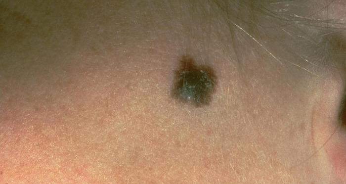 This photo provided by the American Academy of Dermatology shows a typical presentation of a suspicious mole that eventually was diagnosed as melanoma. Even after regulators updated standards for labeling sunscreen in 2012, tests have shown many provide far less protection than advertised. Thats a worry because too much exposure to the ultraviolet rays produced by the sun, along with summertime heat and visible light, can lead to skin cancer, including melanoma, the deadliest type. (American Academy of Dermatology via AP) MANDATORY CREDIT [CopyrightNotice: American Academy of Dermatology]