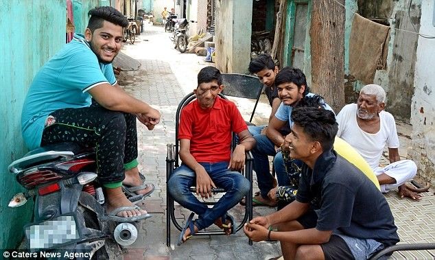 Djaloshi elefant Me fytyren e shkaterruar nga tumori nuk ndjehet mire te del nga fshati foto 2