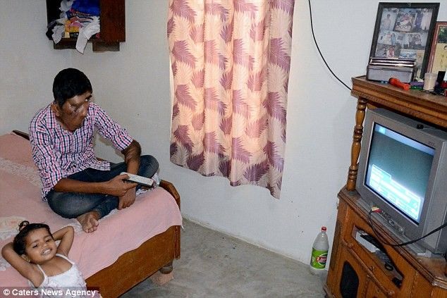 Djaloshi elefant Me fytyren e shkaterruar nga tumori nuk ndjehet mire te del nga fshati foto 4