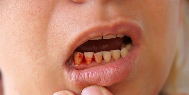 bleeding-gums